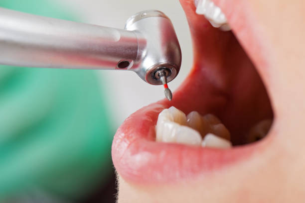 Best Emergency Root Canal Treatment in Middlebranch, OH